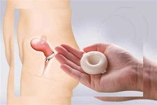 Doğum Kontrol Diyafram Nedir?